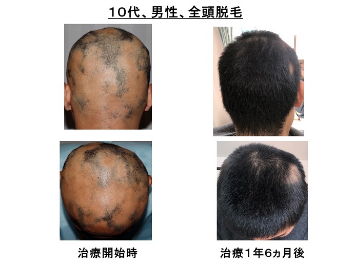 円形脱毛症　病院